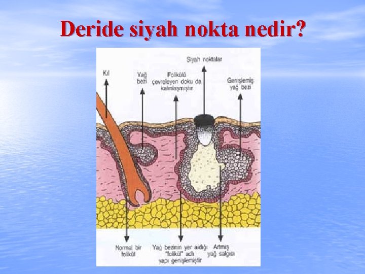 Deride siyah nokta nedir? 