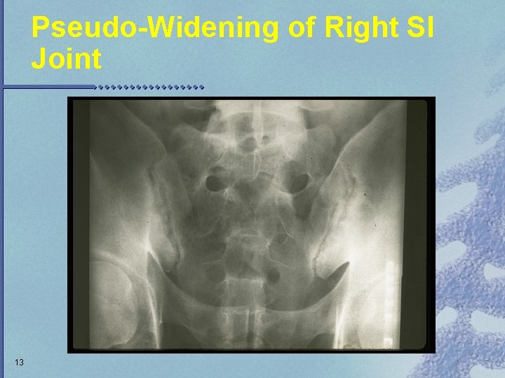 Pseudo-Widening of Right SI Joint 13 