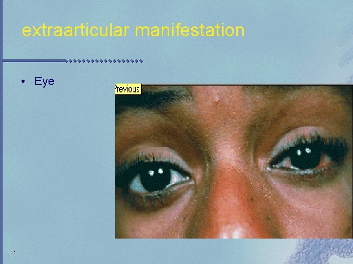 extraarticular manifestation • Eye 31 