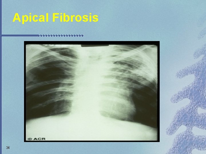 Apical Fibrosis 34 