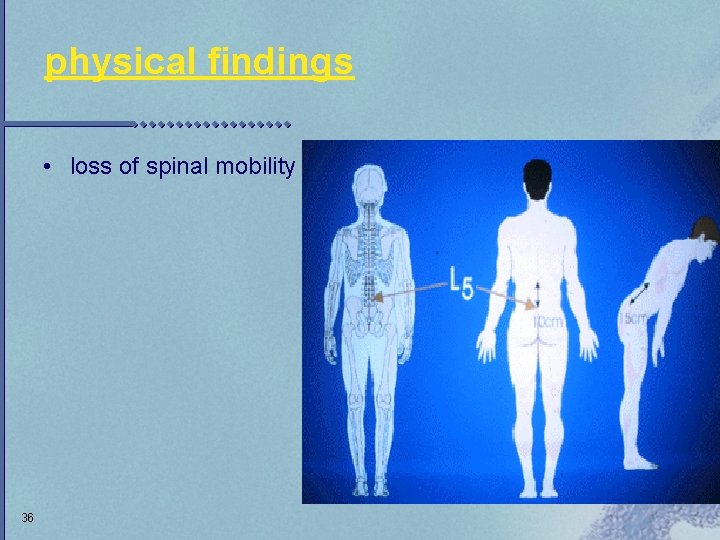 physical findings • loss of spinal mobility 36 