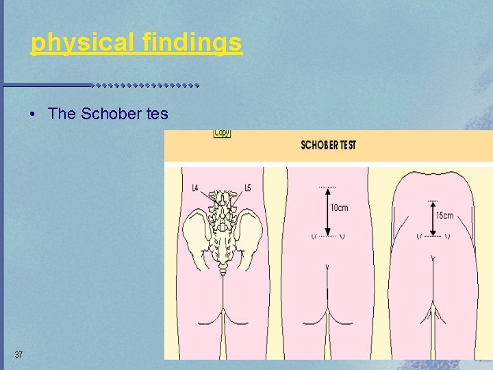 physical findings • The Schober tes 37 