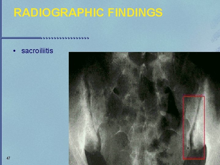 RADIOGRAPHIC FINDINGS • sacroiliitis 47 