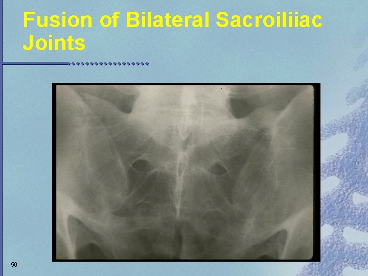 Fusion of Bilateral Sacroiliiac Joints 50 