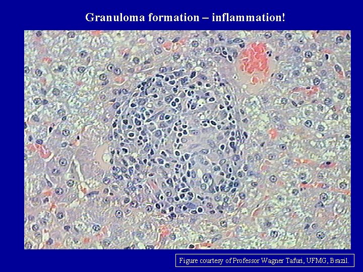 Granuloma formation – inflammation! Figure courtesy of Professor Wagner Tafuri, UFMG, Brazil. 