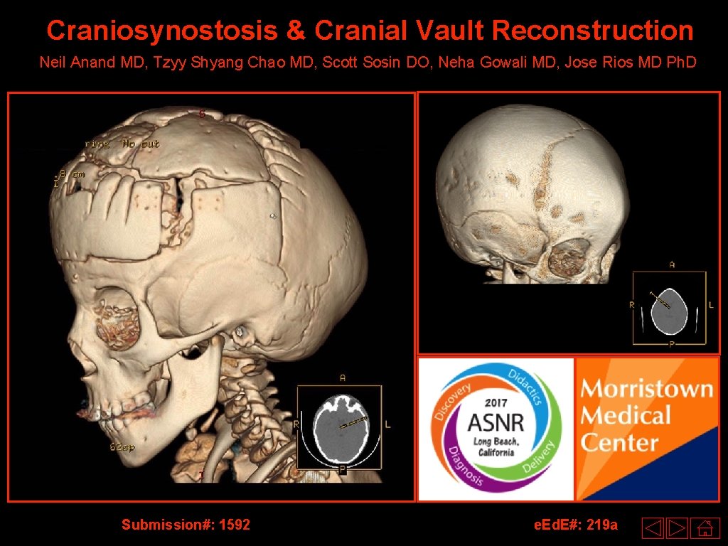 Craniosynostosis & Cranial Vault Reconstruction Neil Anand MD, Tzyy Shyang Chao MD, Scott Sosin