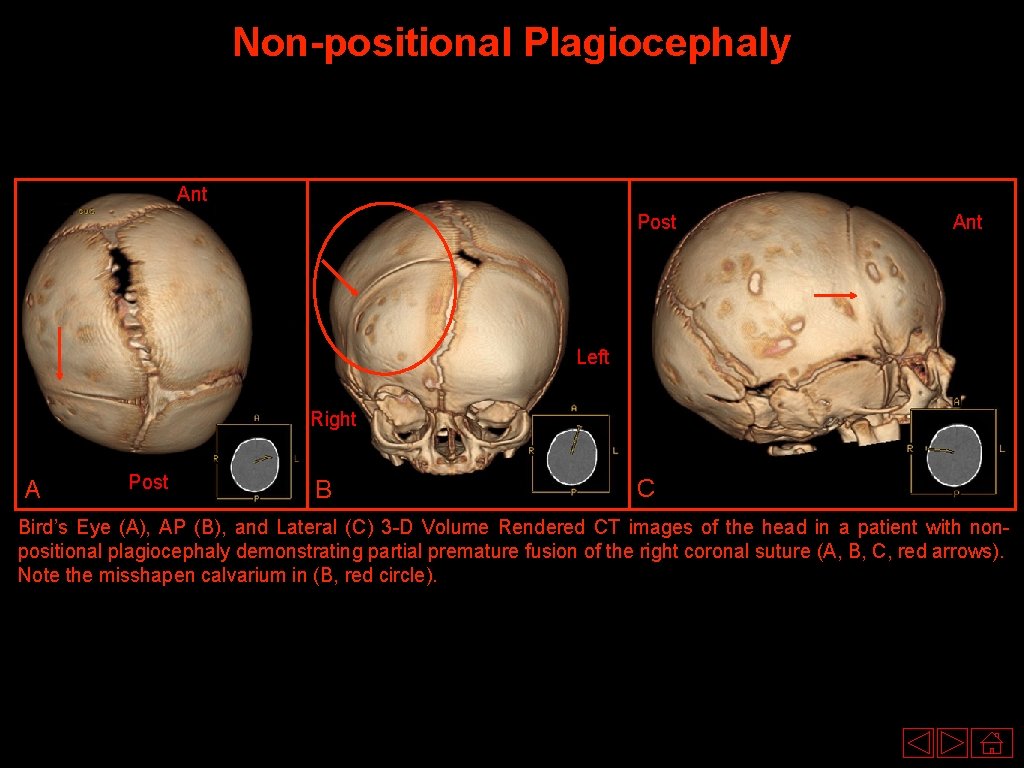 Non-positional Plagiocephaly Ant Post Ant Left Right A Post B C Bird’s Eye (A),