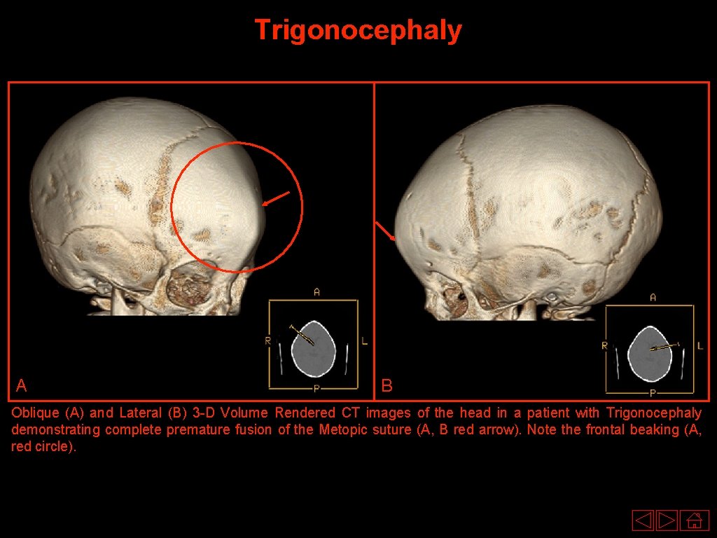 Trigonocephaly A B Oblique (A) and Lateral (B) 3 -D Volume Rendered CT images