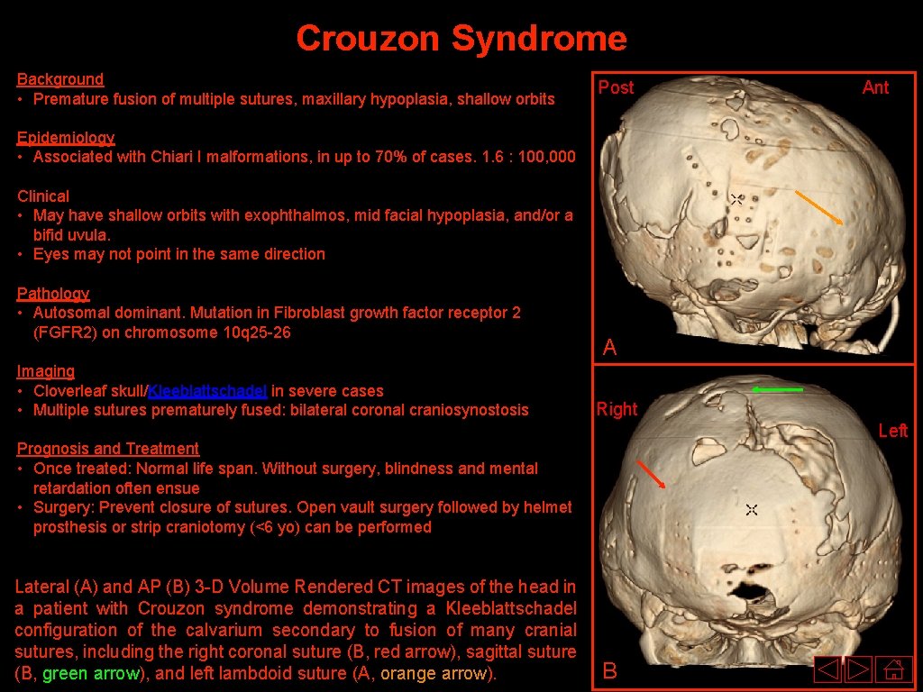 Crouzon Syndrome Background • Premature fusion of multiple sutures, maxillary hypoplasia, shallow orbits Post