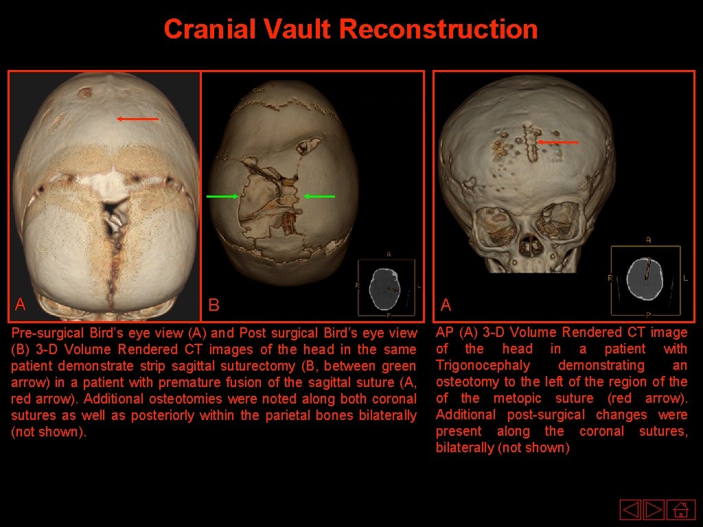 Cranial Vault Reconstruction A B Pre-surgical Bird’s eye view (A) and Post surgical Bird’s