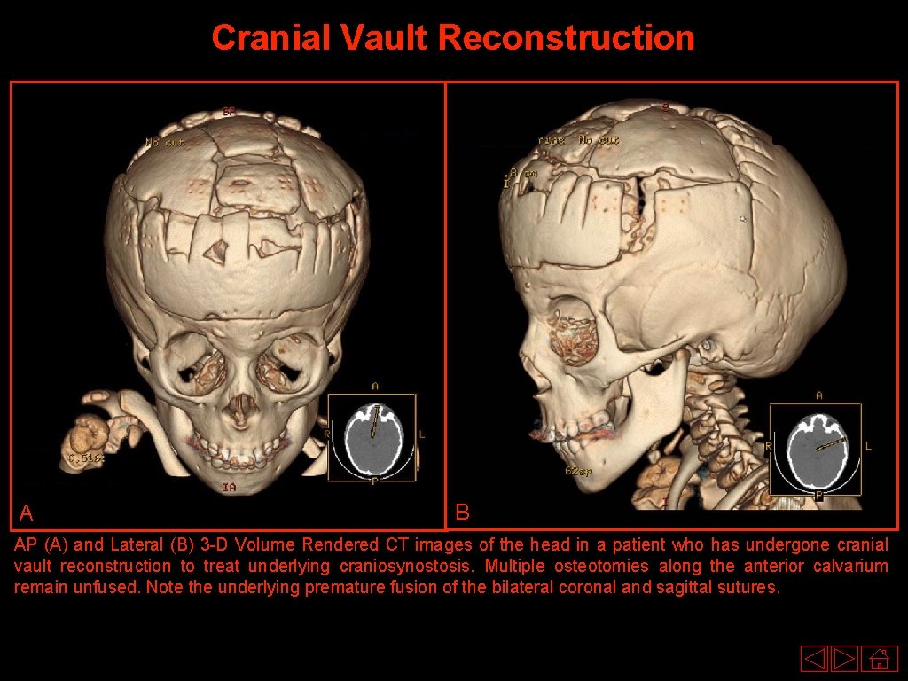Cranial Vault Reconstruction A B AP (A) and Lateral (B) 3 -D Volume Rendered