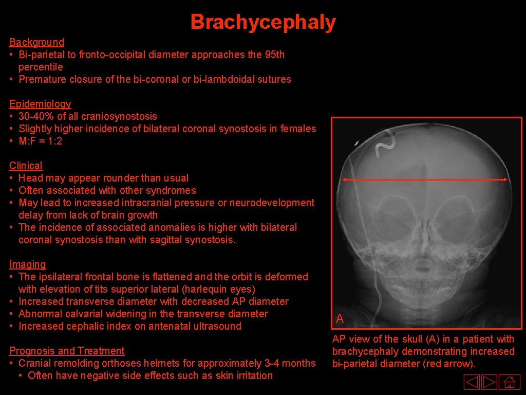 Brachycephaly Background • Bi-parietal to fronto-occipital diameter approaches the 95 th percentile • Premature