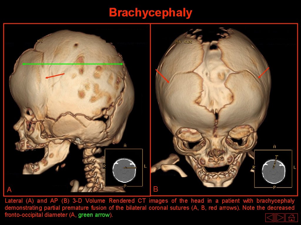 Brachycephaly A B Lateral (A) and AP (B) 3 -D Volume Rendered CT images