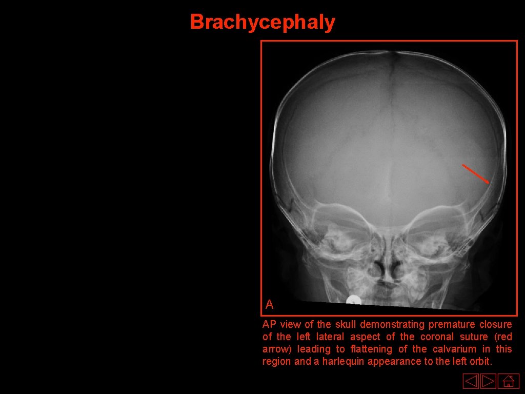 Brachycephaly A AP view of the skull demonstrating premature closure of the left lateral