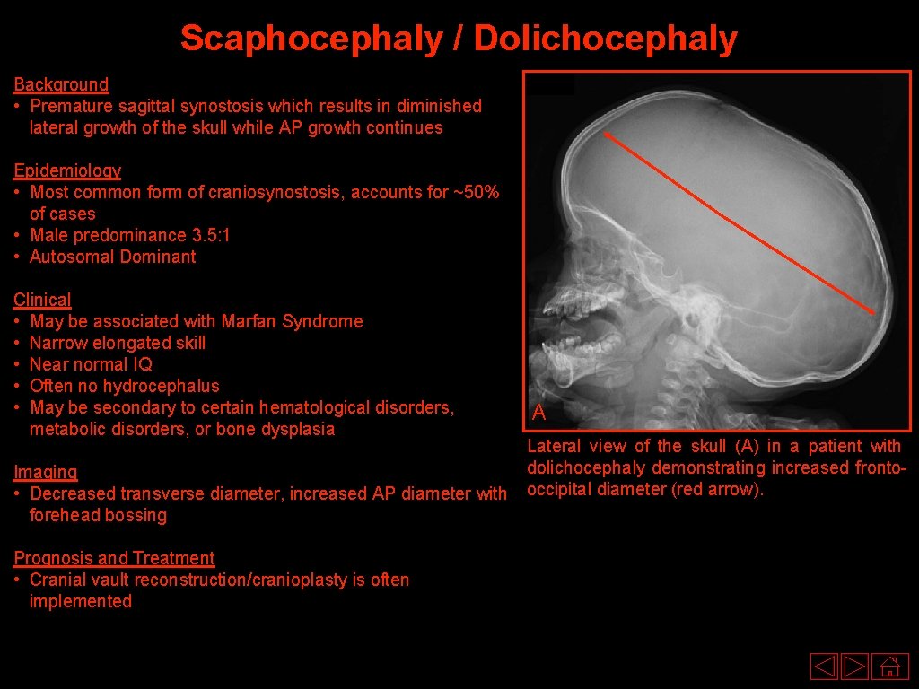 Scaphocephaly / Dolichocephaly Background • Premature sagittal synostosis which results in diminished lateral growth