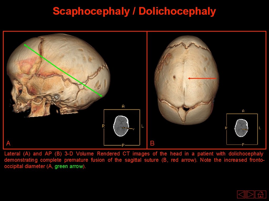 Scaphocephaly / Dolichocephaly A B Lateral (A) and AP (B) 3 -D Volume Rendered