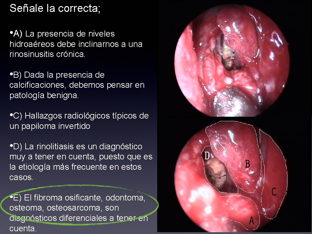 Señale la correcta; • A) La presencia de niveles hidroaéreos debe inclinarnos a una