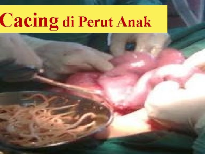 Cacing di Perut Anak 
