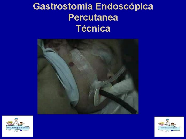 Gastrostomía Endoscópica Percutanea Técnica 