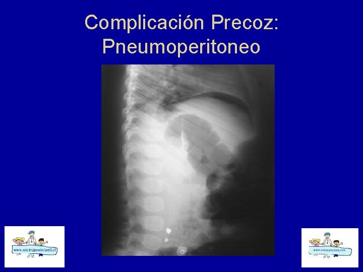 Complicación Precoz: Pneumoperitoneo 