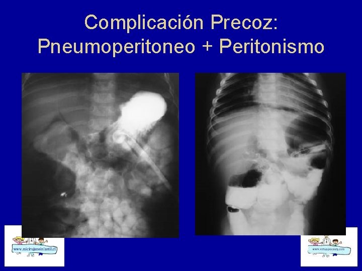 Complicación Precoz: Pneumoperitoneo + Peritonismo 