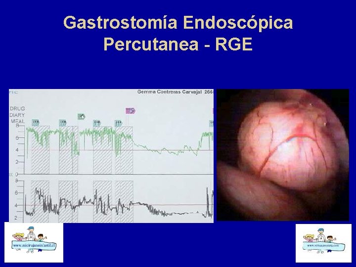 Gastrostomía Endoscópica Percutanea - RGE 