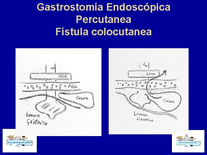 Gastrostomía Endoscópica Percutanea Fístula colocutanea 