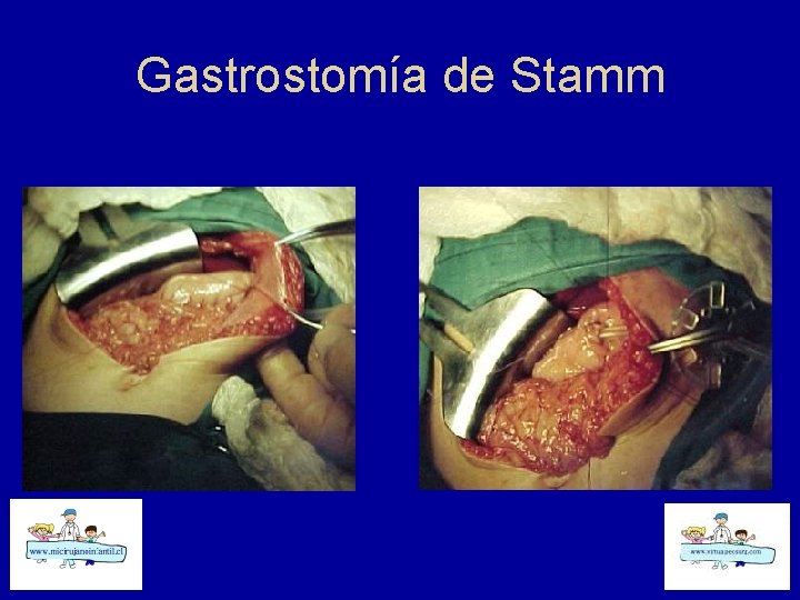 Gastrostomía de Stamm 