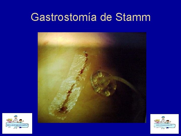 Gastrostomía de Stamm 