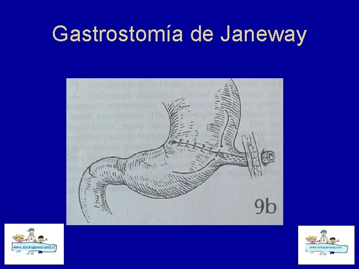 Gastrostomía de Janeway 