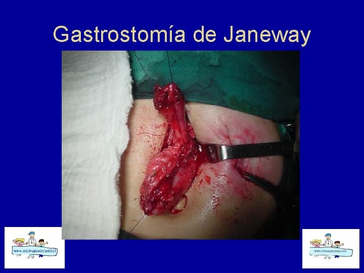 Gastrostomía de Janeway 