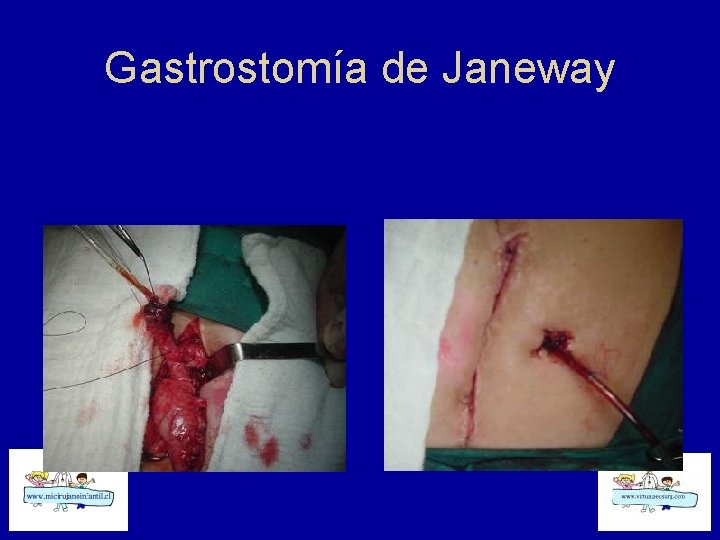 Gastrostomía de Janeway 