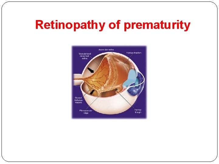 Retinopathy of prematurity 