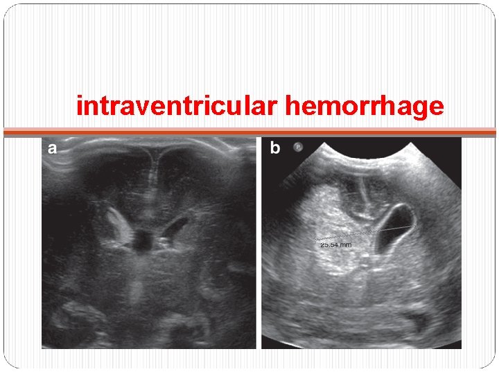 intraventricular hemorrhage 