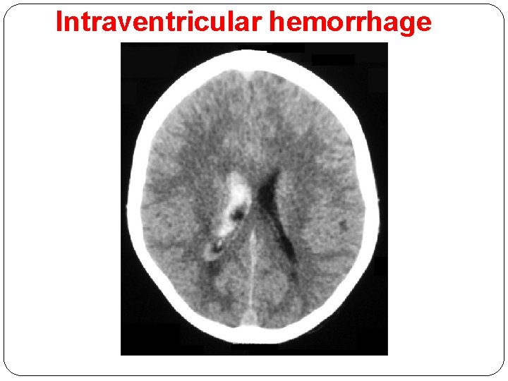 Intraventricular hemorrhage 