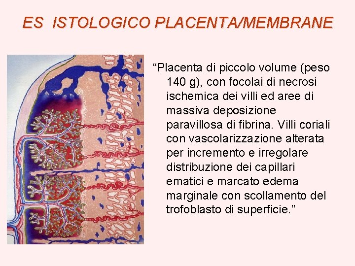 ES ISTOLOGICO PLACENTA/MEMBRANE “Placenta di piccolo volume (peso 140 g), con focolai di necrosi