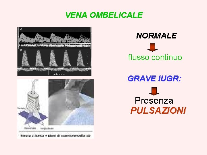 VENA OMBELICALE NORMALE flusso continuo GRAVE IUGR: Presenza PULSAZIONI 