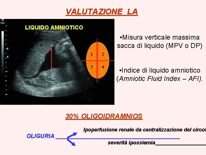 VALUTAZIONE LA • Misura verticale massima sacca di liquido (MPV o DP) • Indice VALUTAZIONE LA • Misura verticale massima sacca di liquido (MPV o DP) • Indice