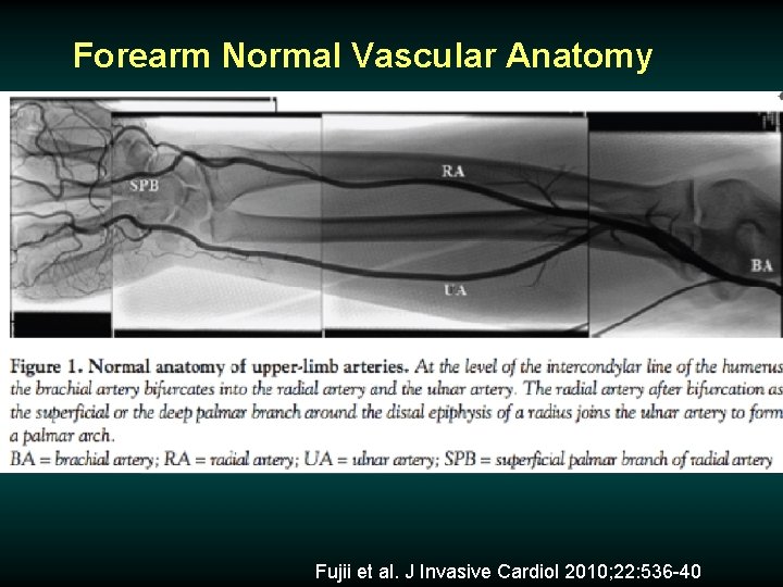 Forearm Normal Vascular Anatomy Fujii et al. J Invasive Cardiol 2010; 22: 536 -40