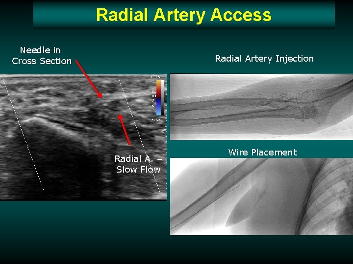 Radial Artery Access Needle in Cross Section Radial Artery Injection Radial A. – Slow