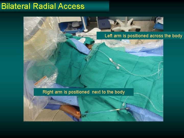 Bilateral Radial Access Left arm is positioned across the body Right arm is positioned