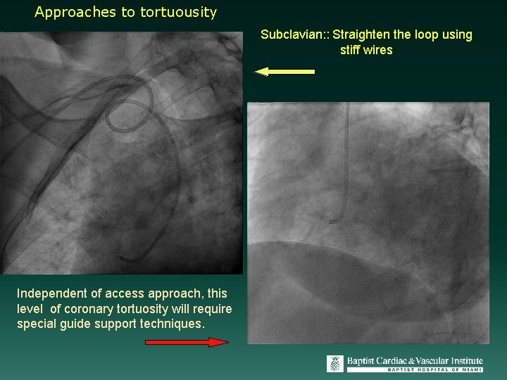 Approaches to tortuousity Subclavian: : Straighten the loop using stiff wires Independent of access