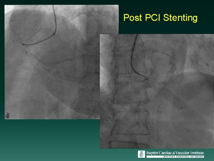 Post PCI Stenting 