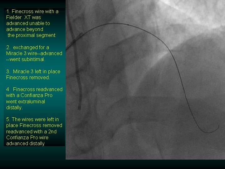 1. Finecross wire with a Fielder XT was advanced unable to advance beyond the