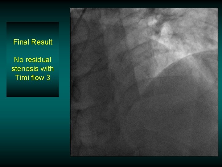 Final Result No residual stenosis with Timi flow 3 