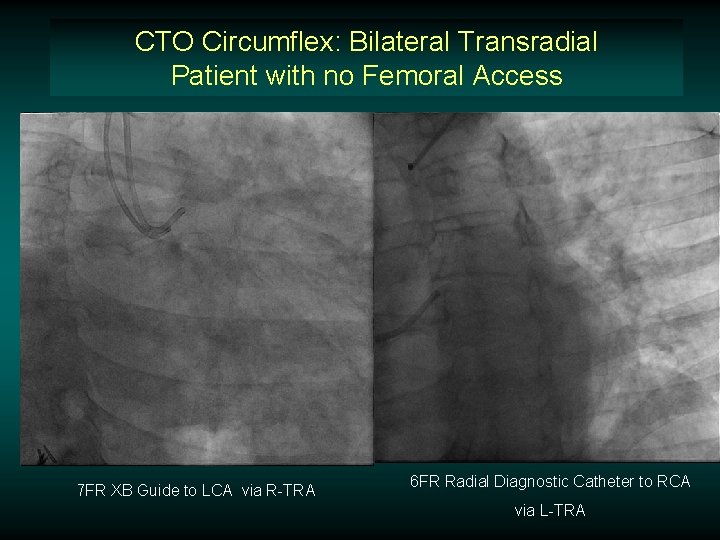 CTO Circumflex: Bilateral Transradial Patient with no Femoral Access 7 FR XB Guide to