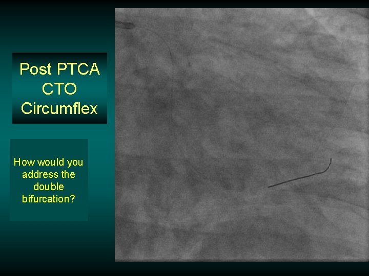 Post PTCA CTO Circumflex How would you address the double bifurcation? 