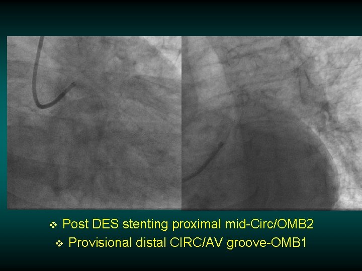 Post DES stenting proximal mid-Circ/OMB 2 v Provisional distal CIRC/AV groove-OMB 1 v 