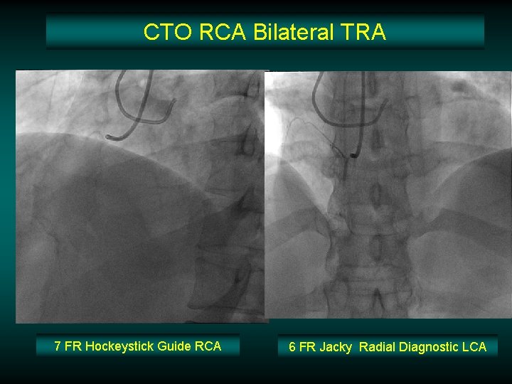 CTO RCA Bilateral TRA 7 FR Hockeystick Guide RCA 6 FR Jacky Radial Diagnostic