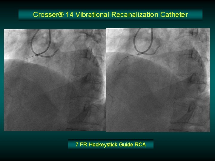 Crosser® 14 Vibrational Recanalization Catheter 7 FR Hockeystick Guide RCA 